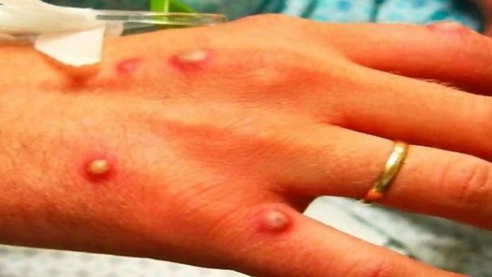Monkeypox-outbreak