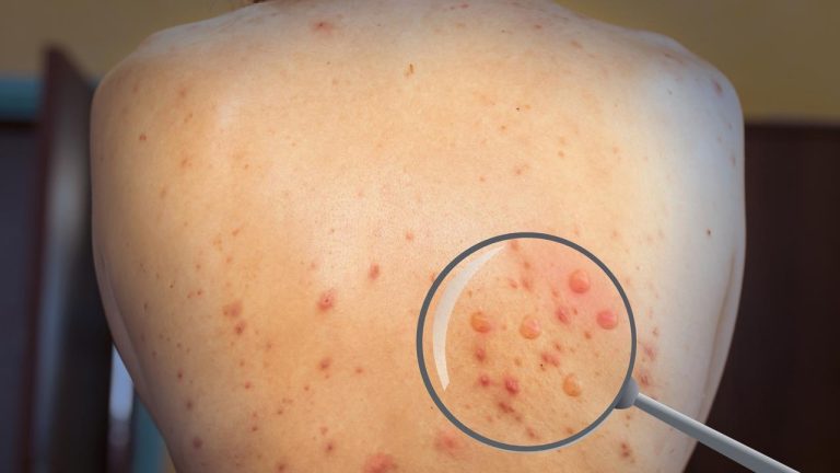 Estudo revela novas dinâmicas de transmissão do monkeypox
